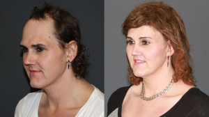Side by side view of one of our proud male to female facial feminization surgery patients.